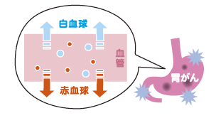 病気 たまる 腹水 が