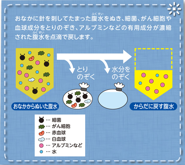 おなかに針を刺してたまった腹水をぬき、細菌、がん細胞や血球成分をとりのぞき、アルブミンなどの有用成分が濃縮された腹水を点滴で戻します。